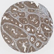 IHC of tissue microarray core of colon cancer stained with DSHB antibody CPTC-ENTPD1-1 against ENTPD1 (brown). Image credit: Clinical Proteomics Technologies for Cancer